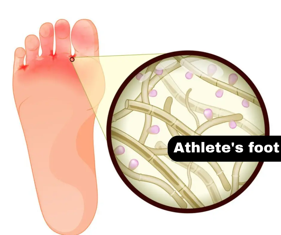 Athlete's Foot: WHAT is Athlete's Foot, symptoms, home remedies, Causes and Risk Factors? Everything you need to know