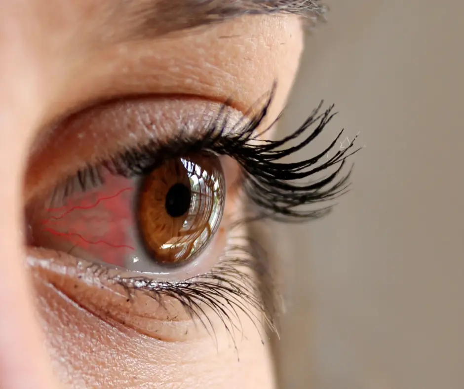 Sore Eyes: Causes, Home Remedies and Prevention Tips for Sore Eyes